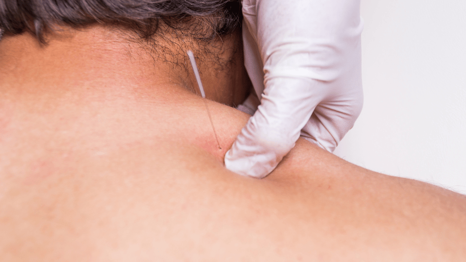 What is Myotherapy? Dry Needling can boost energy flow.